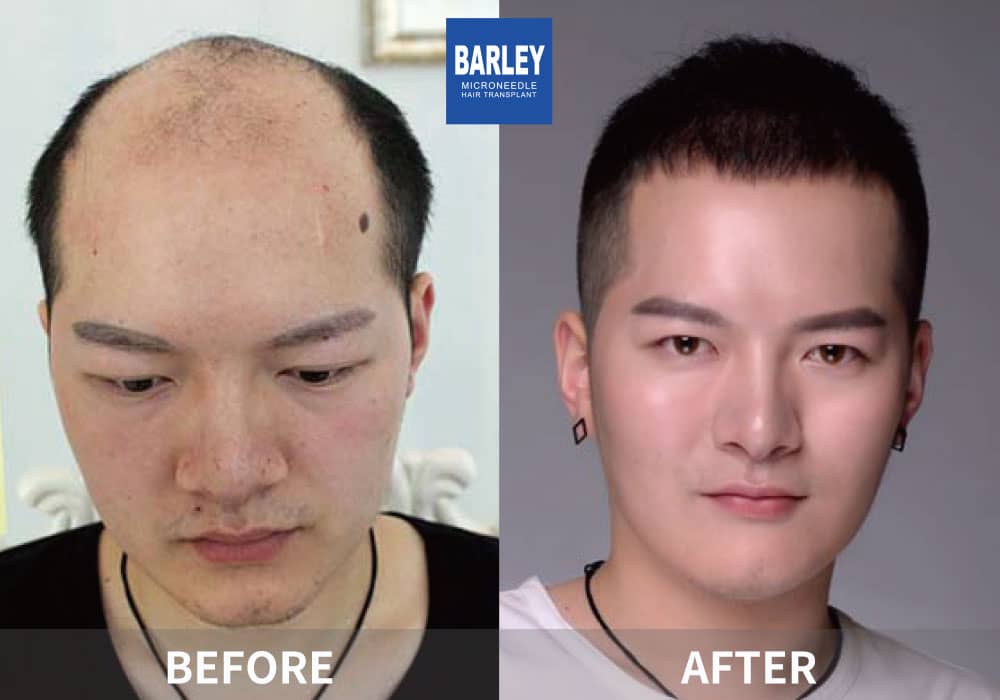 Hair transplant success