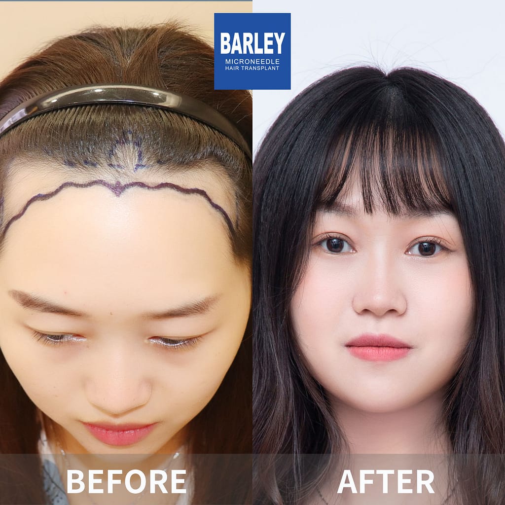 Best Affordable Hair Transplants in Macau