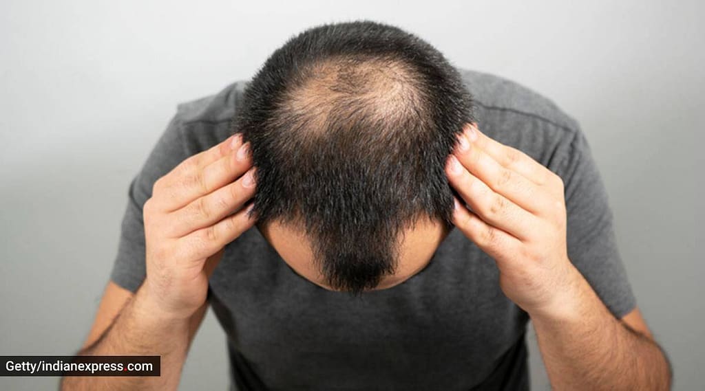 Is Hair loss Genetic? 