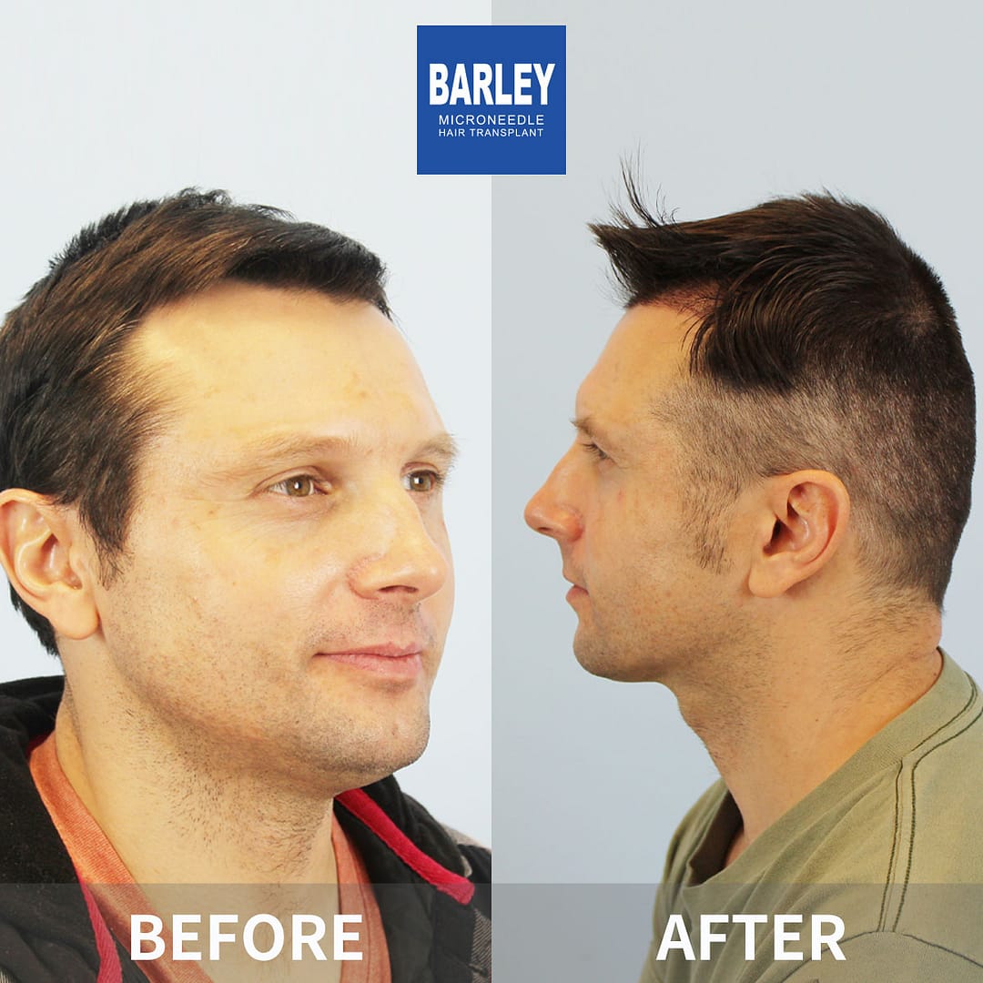 Barley Shanghai hair transplant results
