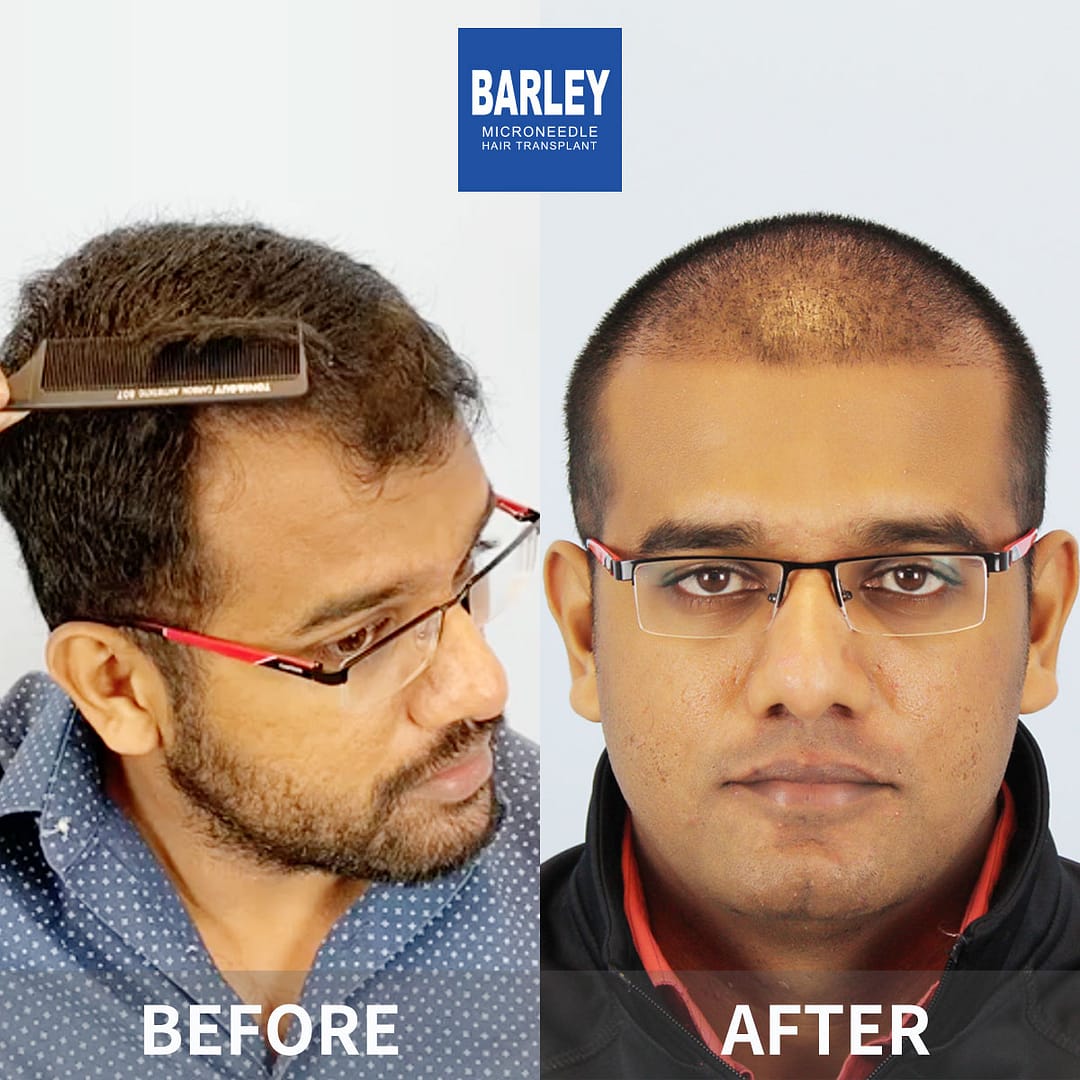 Barley shenzhen hair transplant results