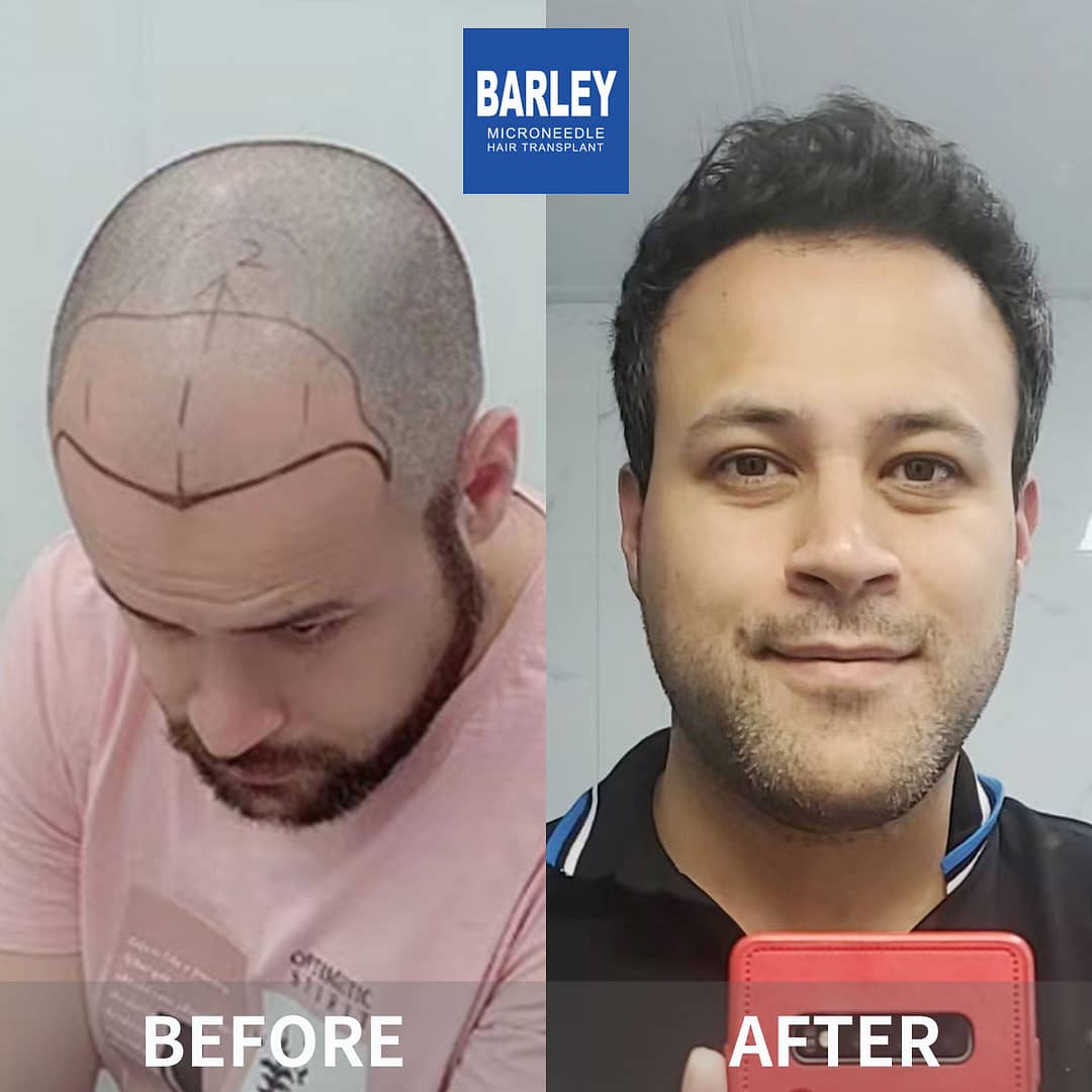Hair restoration results