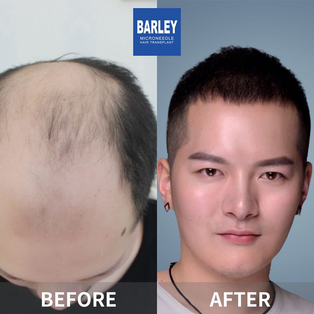 barley hair restoration results