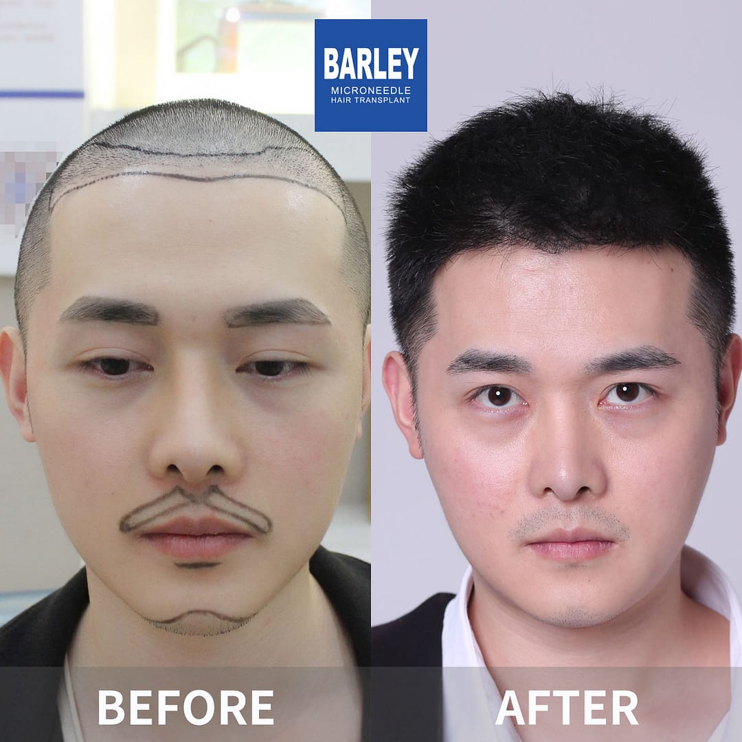 Beard transplant results