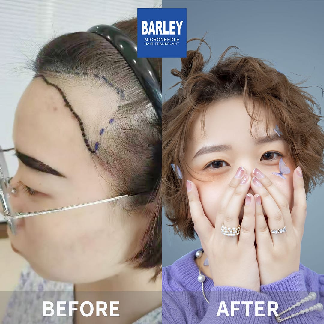 female hair transplant result