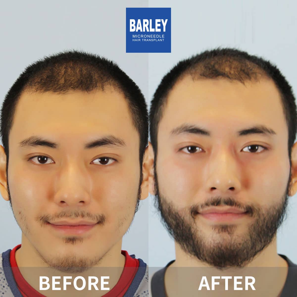 beard transplant in China