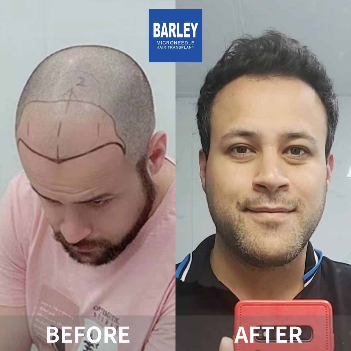 Hair transplant result in CHina