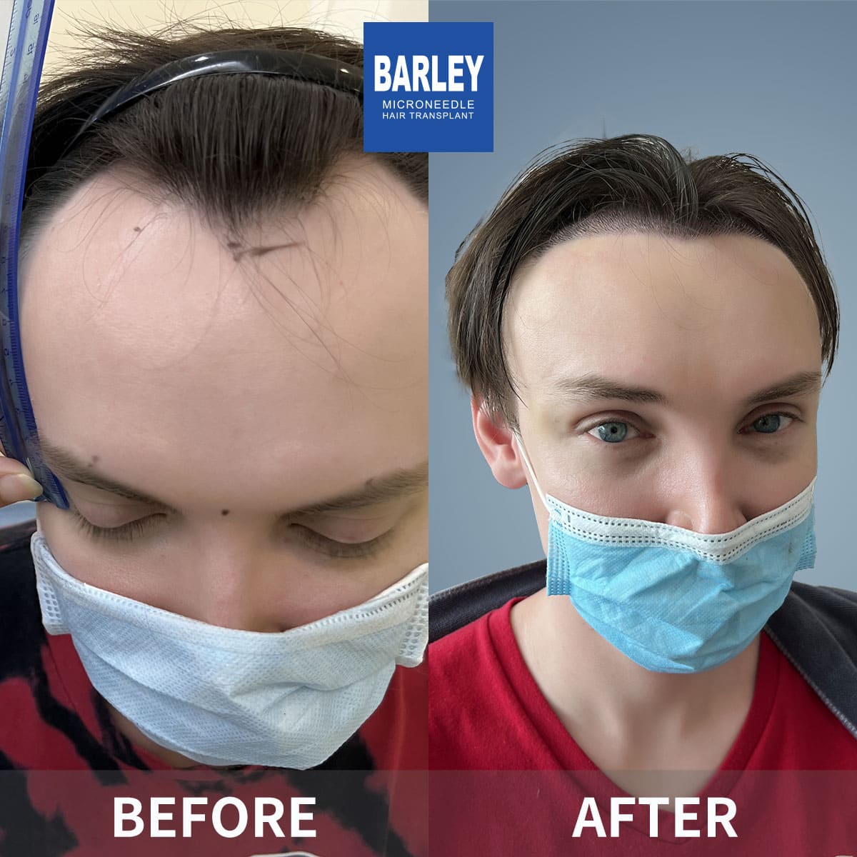 hair transplant after 10 years