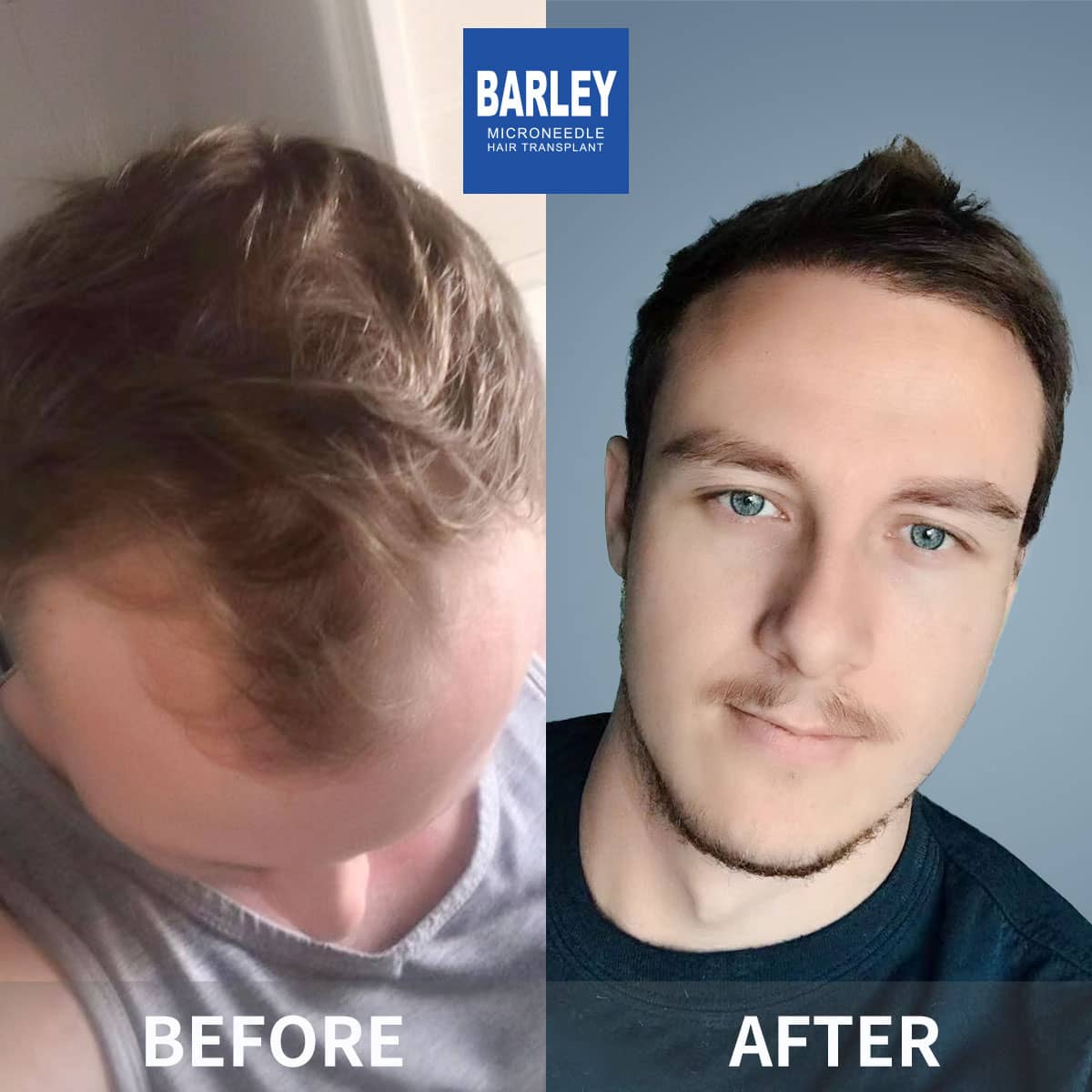 Hair transplant Results