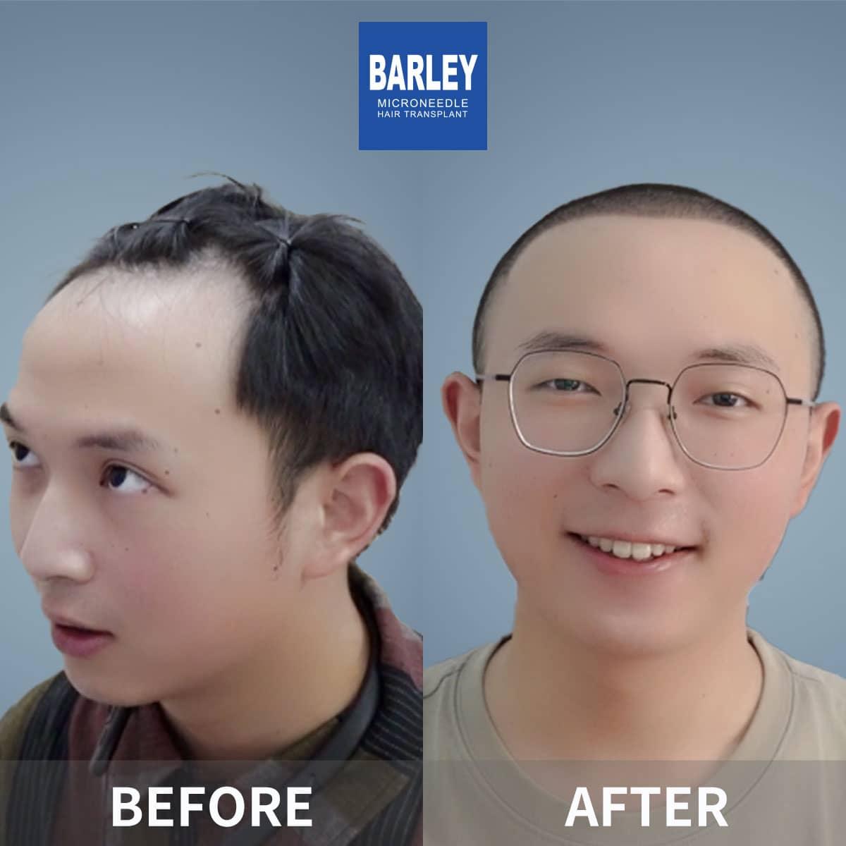 Hair transplant in Chengdu
