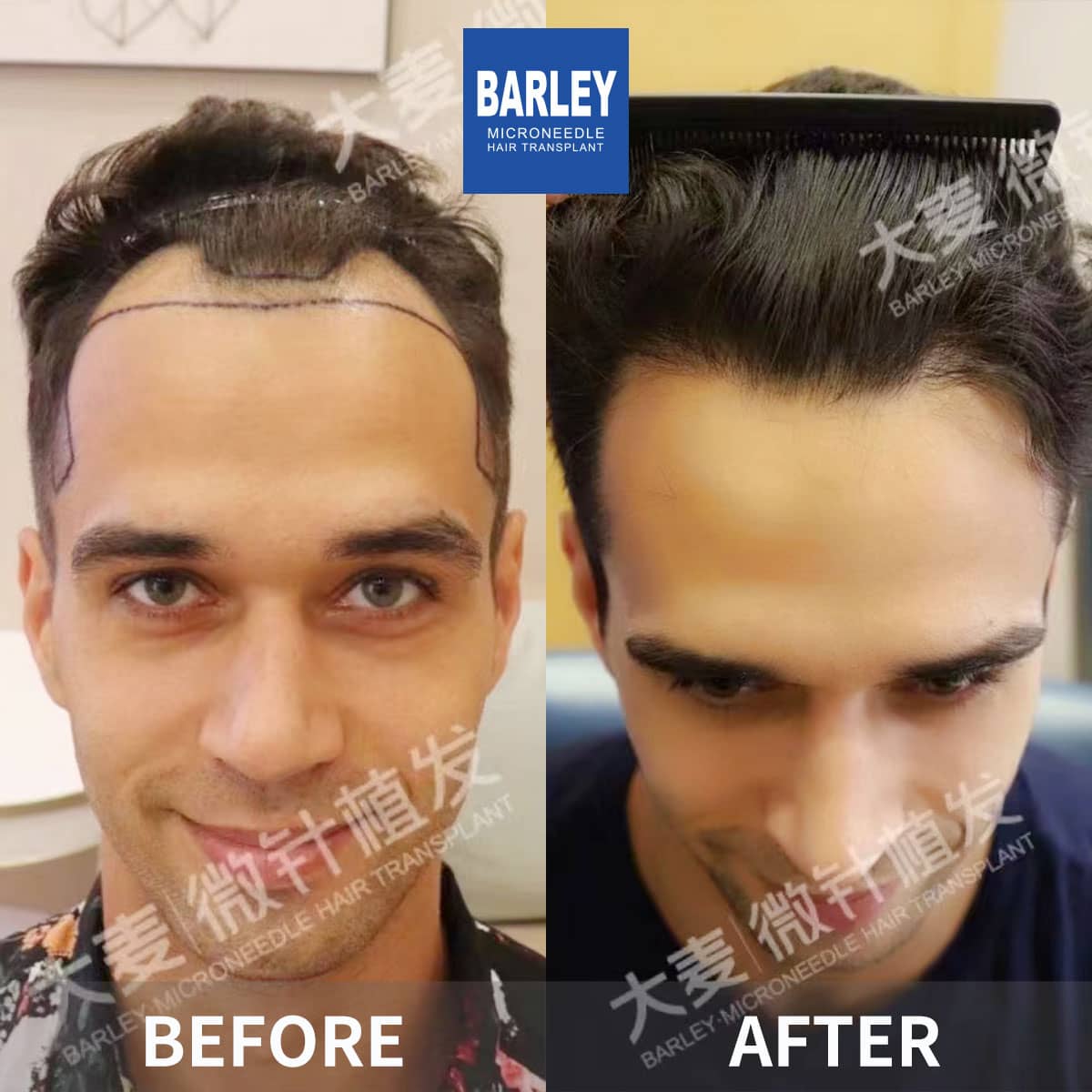 hair line transplant results