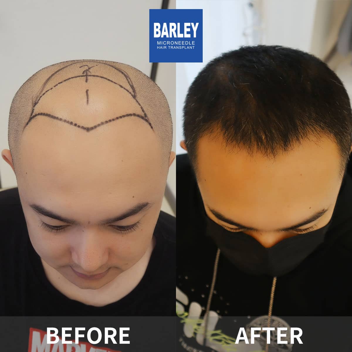 Barley hair transplant results