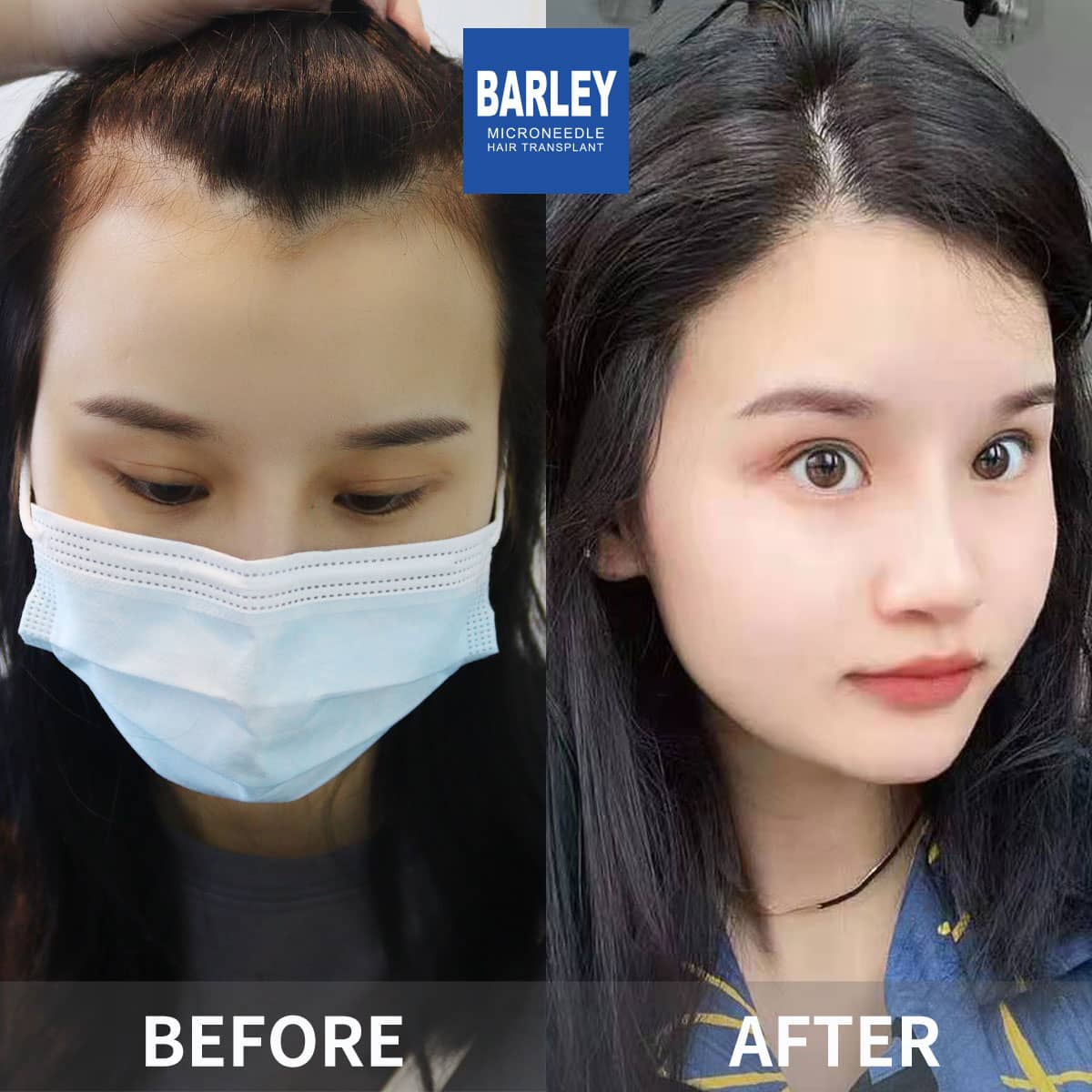female hair restoration results
