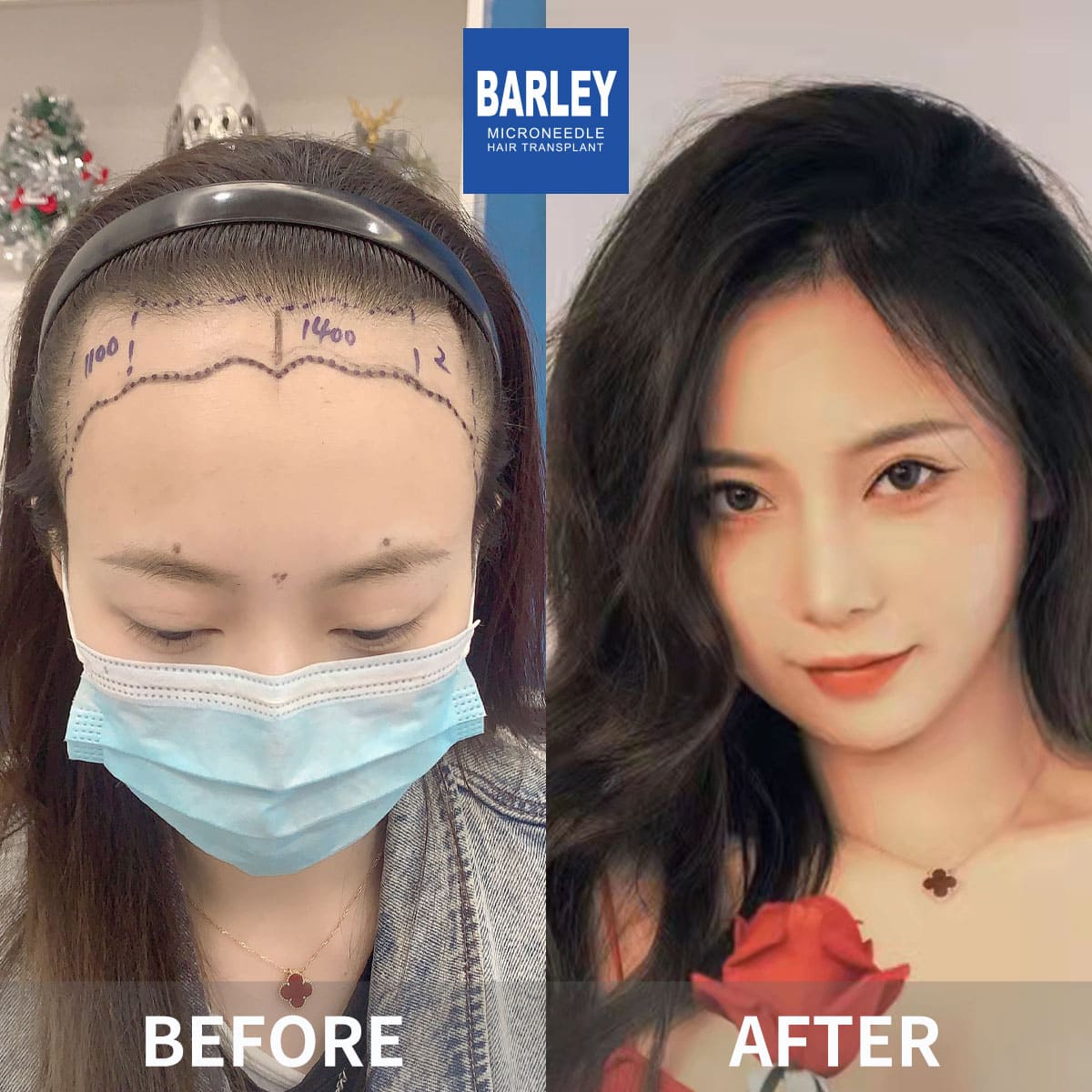 Female hair line transplant