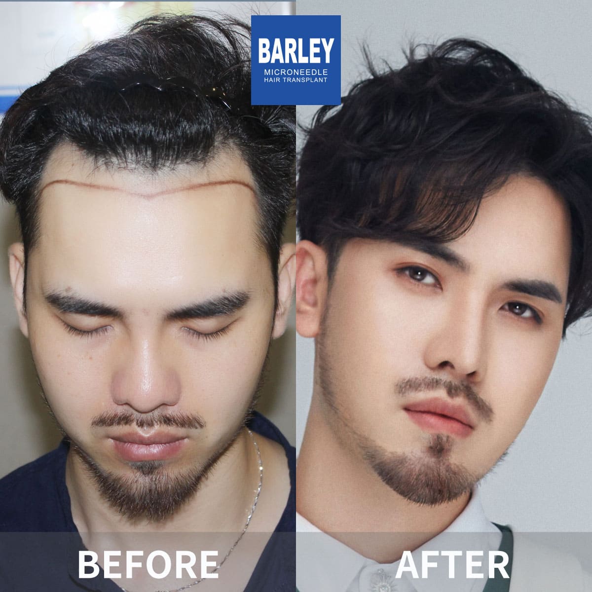 Hair loss treatment results