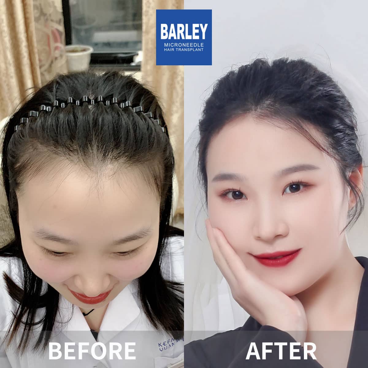 hair restoration results