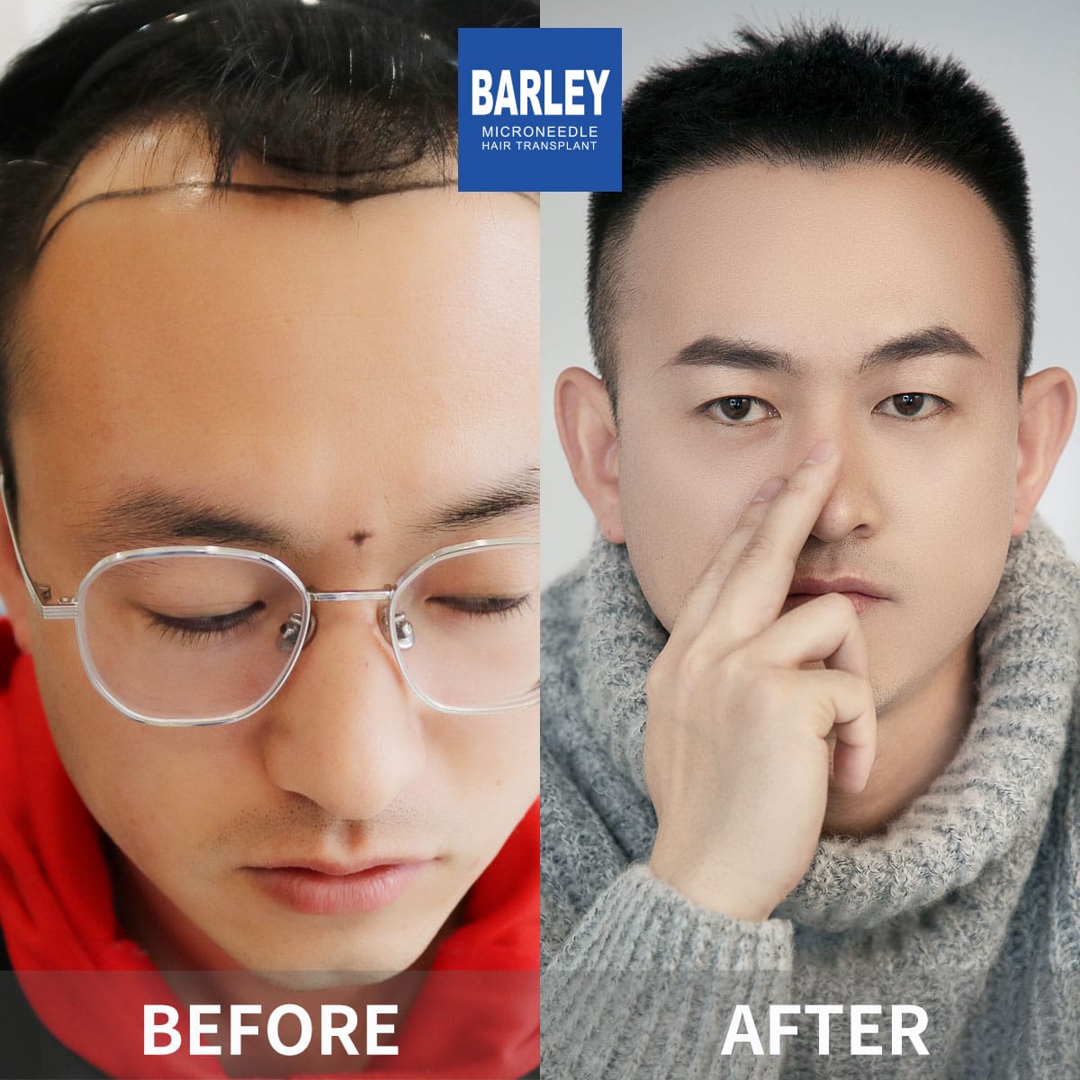 Hair Transplant in Wenzhou