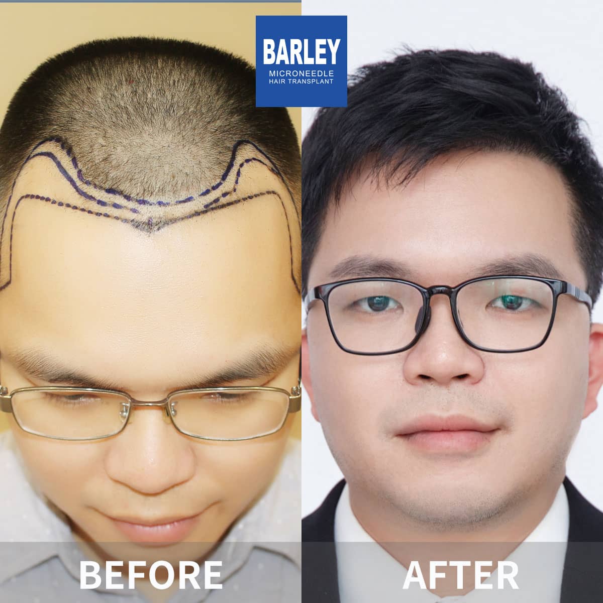 Hair Transplant in Nanchang