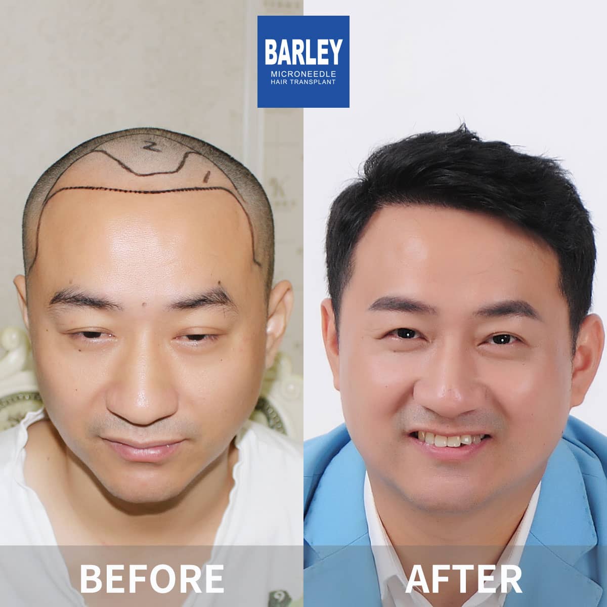 barley hair restoration results