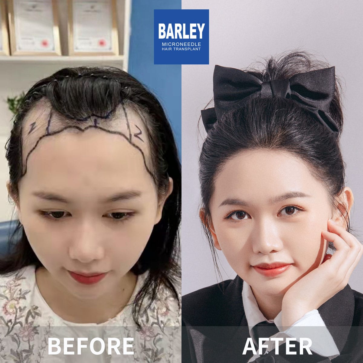 barley hair transplant results