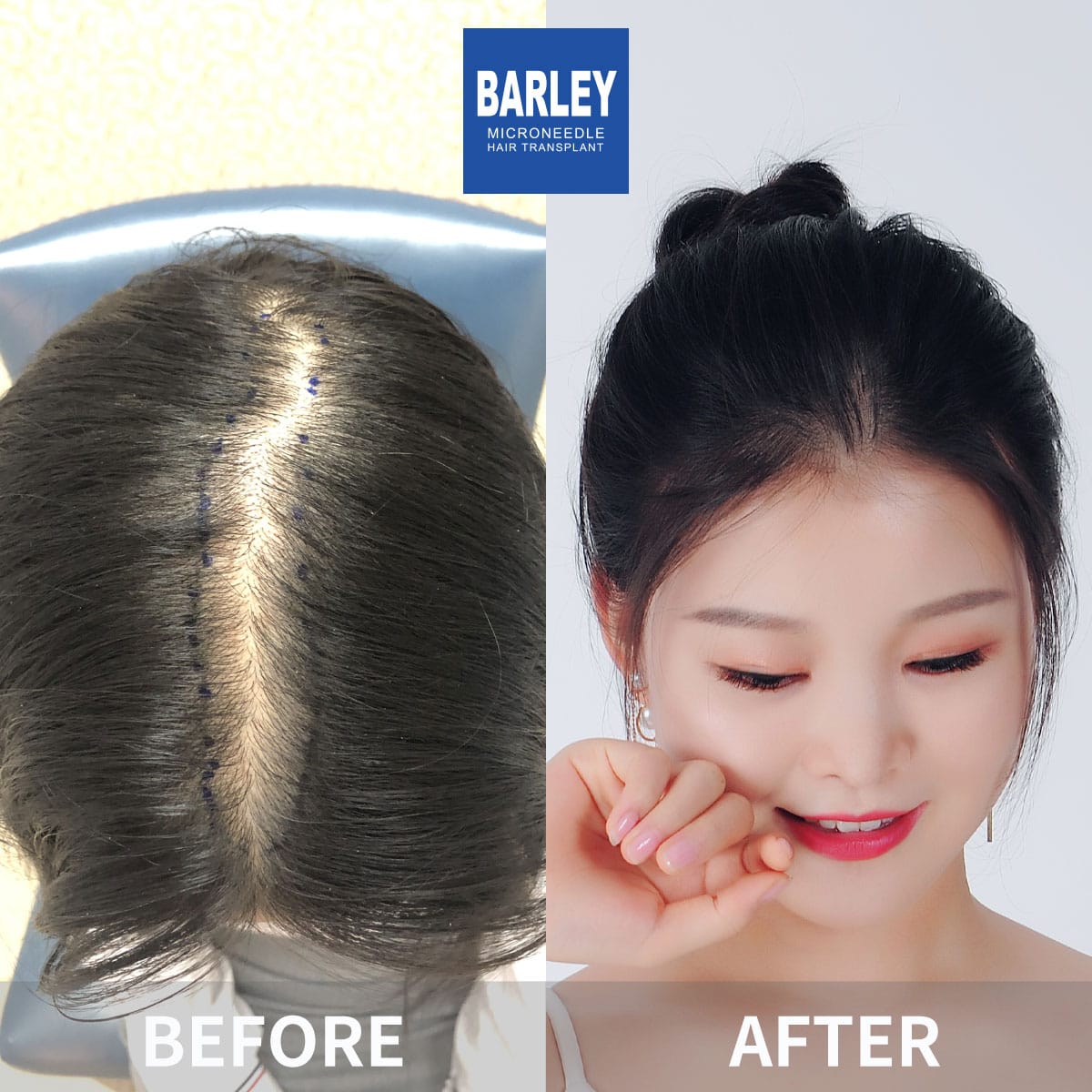 barley before and after hair transplant