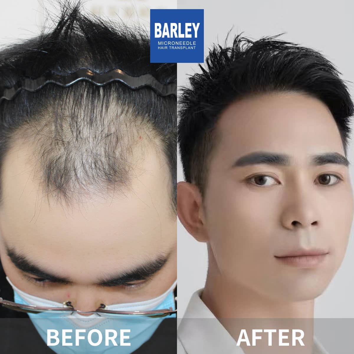 barley before and after results