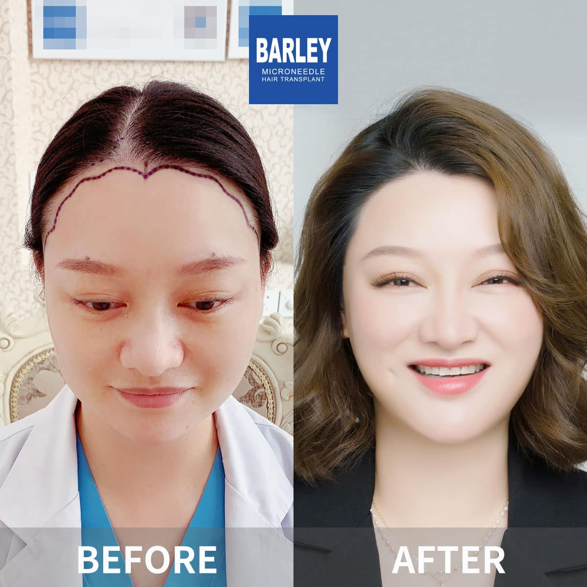 Hair Transplant in Nanchang