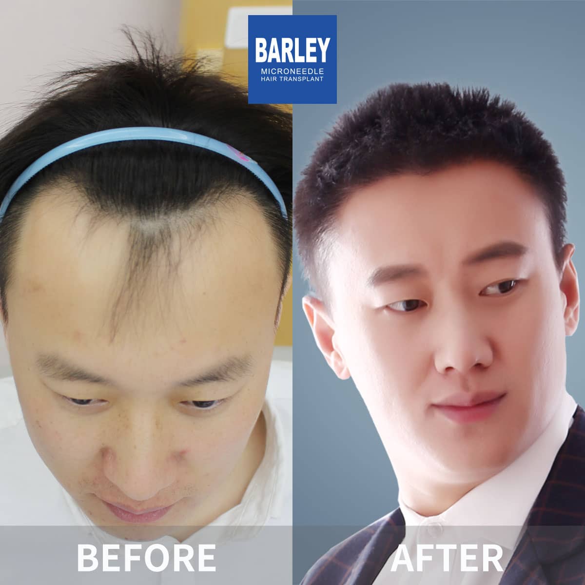 male hair transplant result