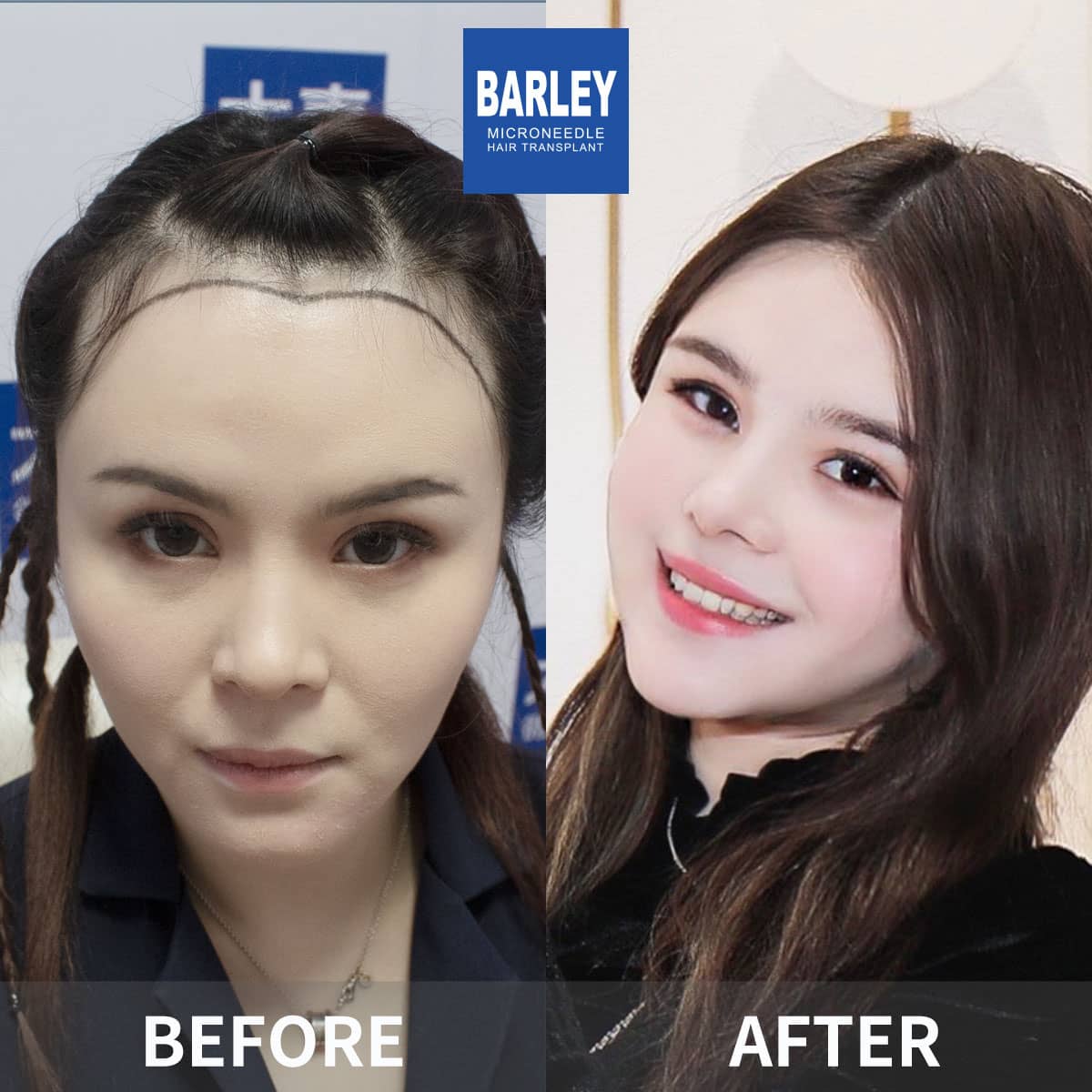 female hair transplant result