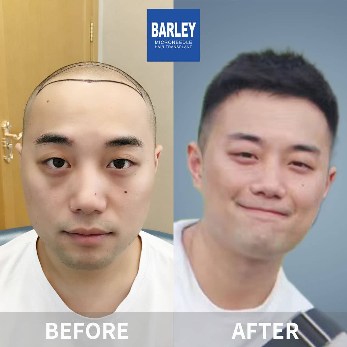barley male hair transplant result