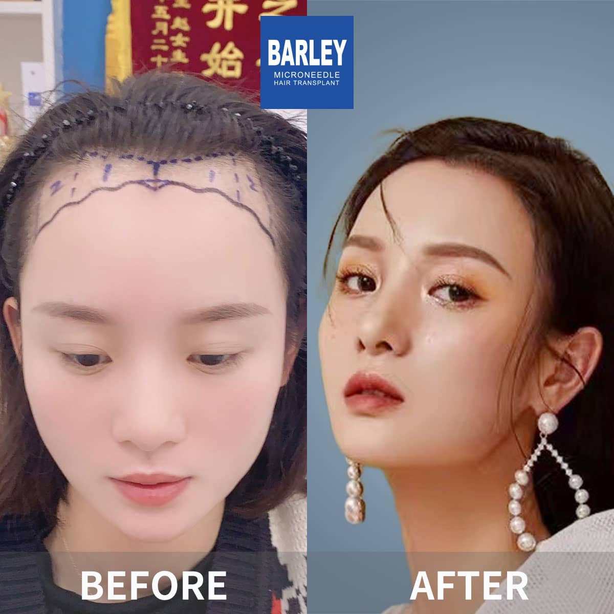 Barley female hair transplant result
