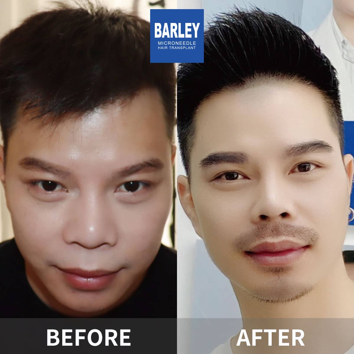 facial hair transplant results
