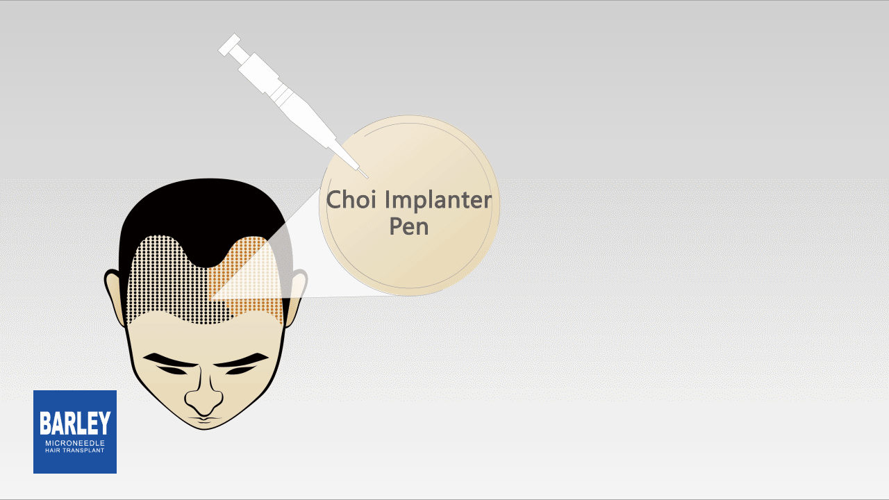 Barley Implanter pen