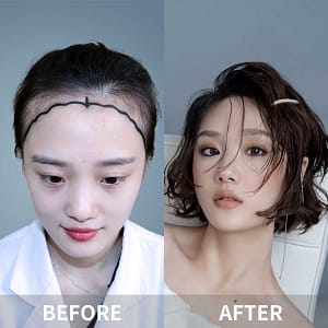 Hair Transplant in Tianjin