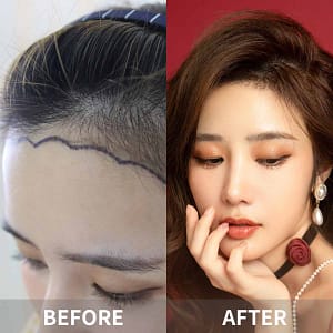 Hair Transplant in Dalian