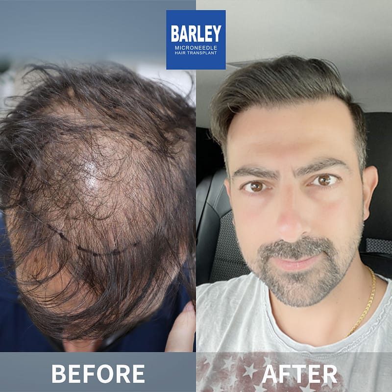 hair transplant after one year results